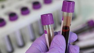 Genetik tehlike... Evlenmeden önce test şart: Talasemi sessizce yayılıyor! Uzmanlar uyardı: Talasemi taşıyıcılık oranı yüzde 2,1