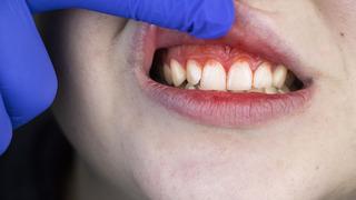 Basit deyip geçiştirmeyin: Ağızdaki bu belirti löseminin ilk işareti olabilir! Aniden başlıyor