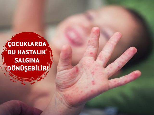 Çocuklarda bu hastalık salgına dönüşebilir!