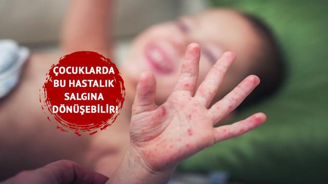 Çocuklarda el, ayak, ağız hastalığı salgın uyarısı! Belirtilere dikkat! Uzmanlar uyarıyor: Ateş ve ağız içi yaralar ile kendini gösterir