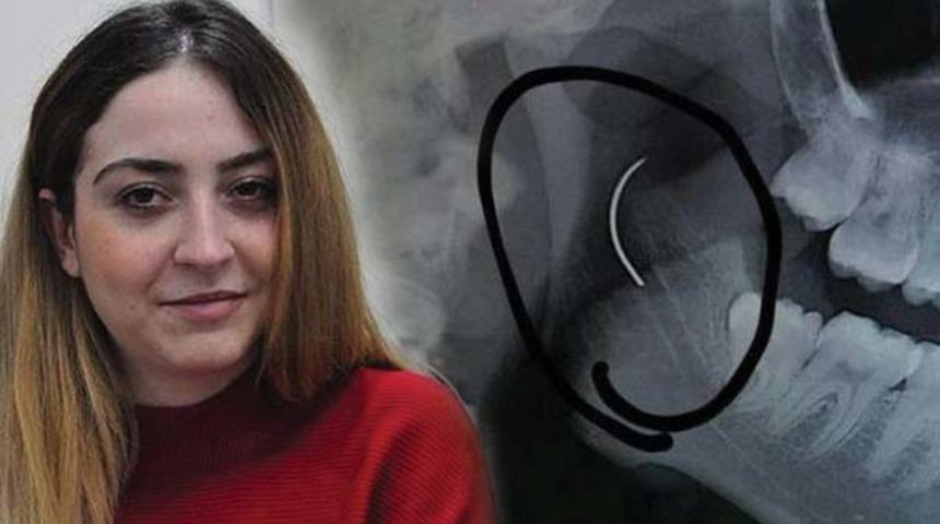 Boğazındaki ameliyat iğnesiyle 18 yıl yaşadı