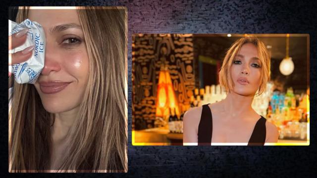  Jennifer Lopez provalarda yaralandı! Buz torbasını kaldırıp gösterdi