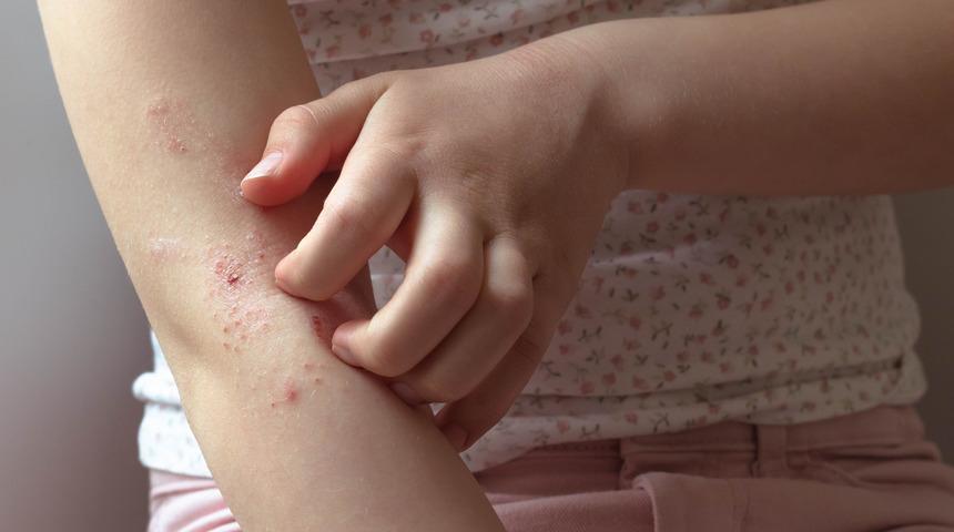 Egzama neden olur? Saçta, elde ve yüzde egzama neden olur? Egzama nedenleri