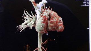 Türkiye'de tek, dünyada ikinci! Kalbi 'yatay' şekilde dünyaya geldi...