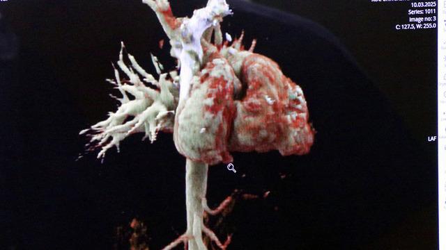 Türkiye'de tek, dünyada ikinci! Kalbi 'yatay' şekilde dünyaya geldi...