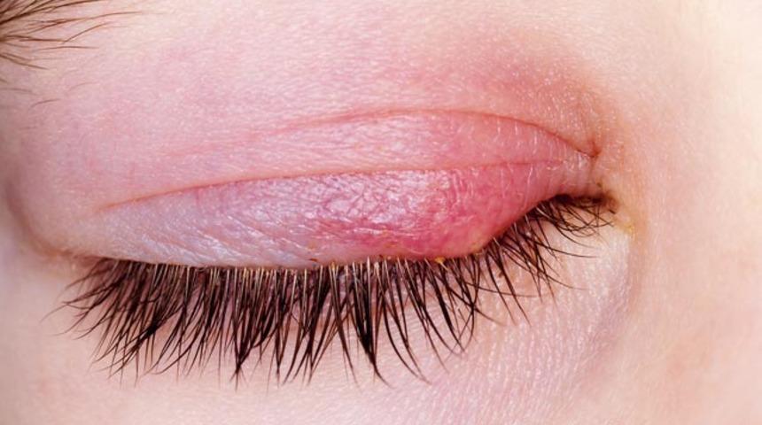 Gözdeki arpacık nasıl geçer? İşte deneyebileceğiniz etkili yöntemler