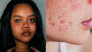 Sivilce tedavisi için gitti, organları iflas etti! Genç kızın hayatı altüst oldu! Milyonlarca insan o ilacı kullanıyor...