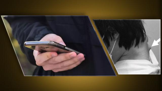 25 yaşındaki gencin boynu yamuldu! Sürekli telefon kullanımı boynunda ağır hasar oluşturdu: Düşük kafa sendromu ile Tıp literatürüne girdi…