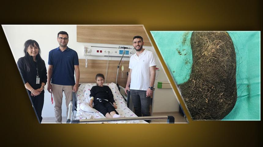 9 yaşındaki çocuğun, ağrısının nedeni dehşete düşürdü! Midesinden saç yumağı çıktı: "Mideyi tamamen doldurmuş" 