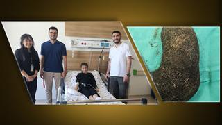 9 yaşındaki çocuğun, ağrısının nedeni dehşete düşürdü! Midesinden saç yumağı çıktı: Mideyi tamamen doldurmuş 