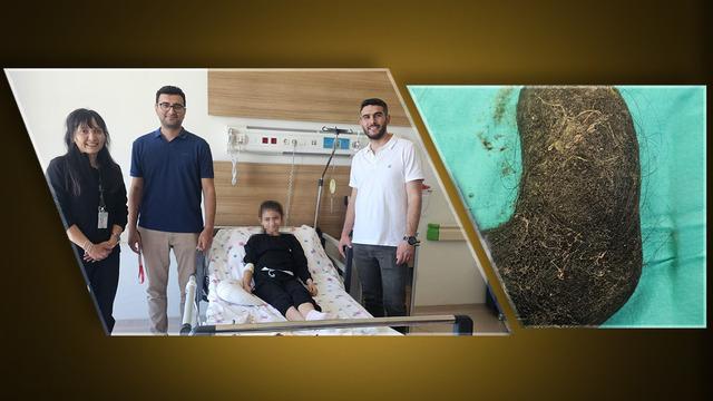 9 yaşındaki çocuğun, ağrısının nedeni dehşete düşürdü! Midesinden saç yumağı çıktı: Mideyi tamamen doldurmuş 