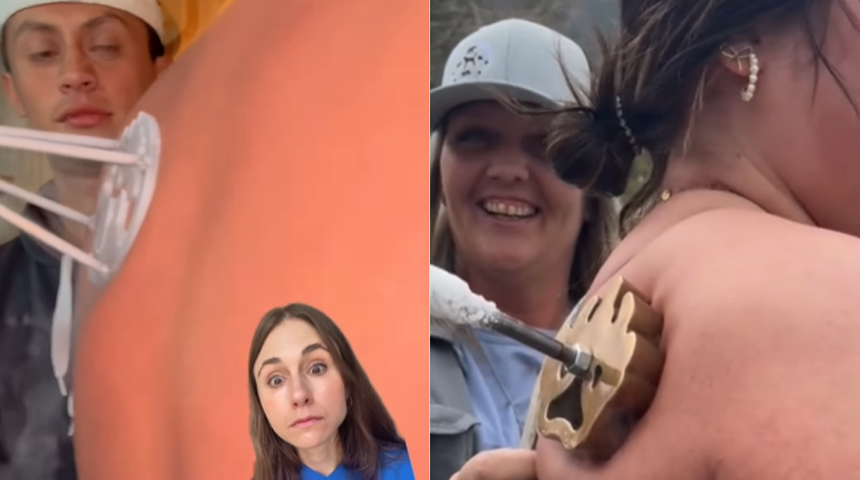 Yeni estetik trendi tehlike saçıyor! Vücutlarına damgalama yapıyorlar ama bakın sonucu ne oluyor! 