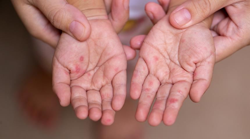 El ayak hastalığı bulaşıcılık süresi nedir? El ayak hastalığı bulaşıcılık süresi ne kadardır, ne zaman biter?