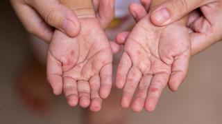 El ayak hastalığı bulaşıcılık süresi nedir? El ayak hastalığı bulaşıcılık süresi ne kadardır, ne zaman biter?