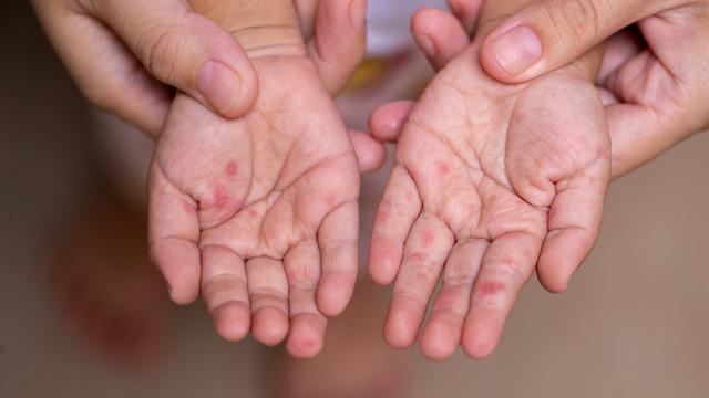 El ayak hastalığı bulaşıcılık süresi nedir? El ayak hastalığı bulaşıcılık süresi ne kadardır, ne zaman biter?