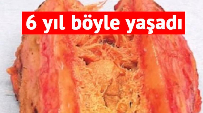 İhmal, hayatına mal oluyordu! Gazlı bezler 6 yıl sonra &ccedil;ıkarıldı