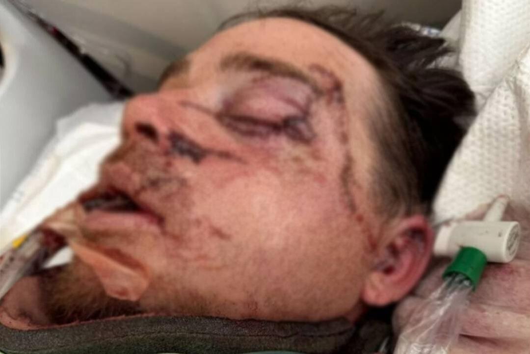 Kullandığı dozerin altında kaldı! Dehşeti yaşayan adamın yüzünün yarısı artık yok 1