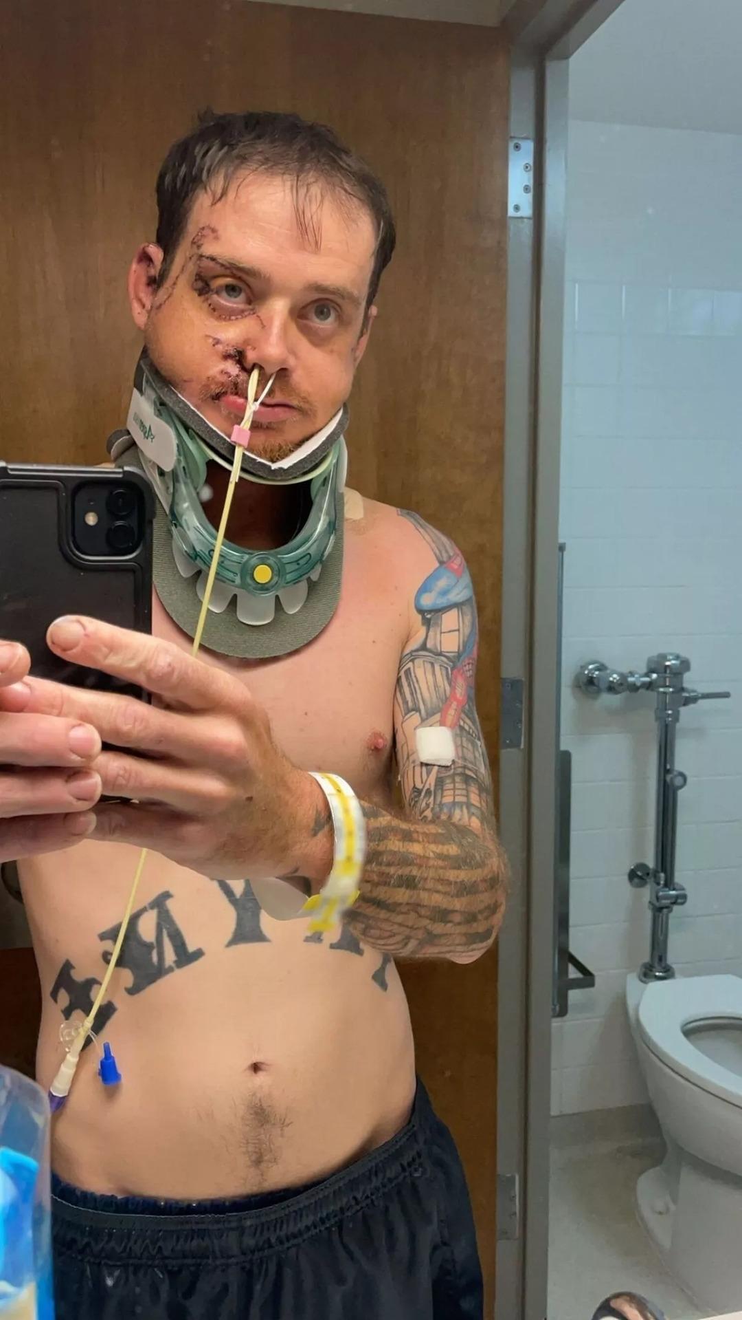 Kullandığı dozerin altında kaldı! Dehşeti yaşayan adamın yüzünün yarısı artık yok 2