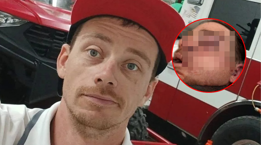 Kullandığı dozerin altında kaldı! Dehşeti yaşayan adamın yüzünün yarısı artık yok