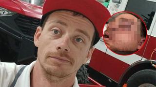 Kullandığı dozerin altında kaldı! Dehşeti yaşayan adamın yüzünün yarısı artık yok