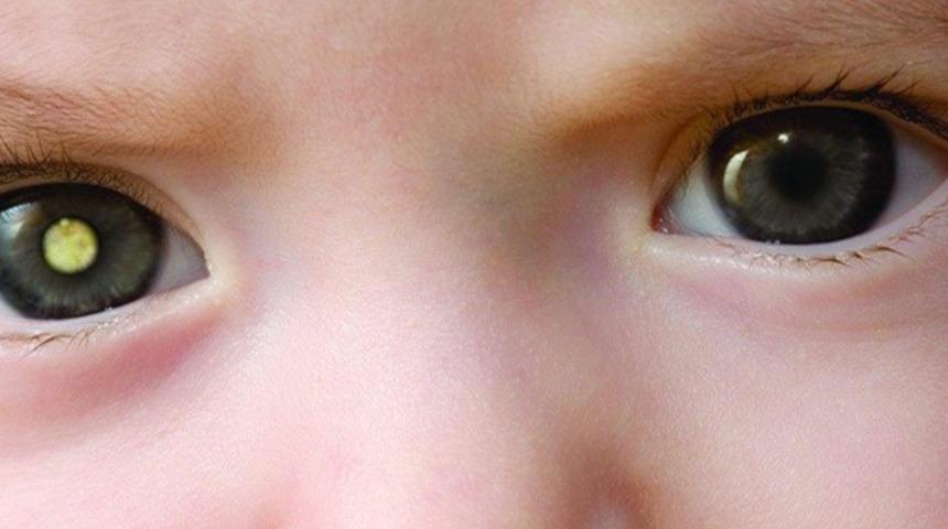 Fotoğraflara dikkatli bakın! Kanseri teşhis edebilirsiniz