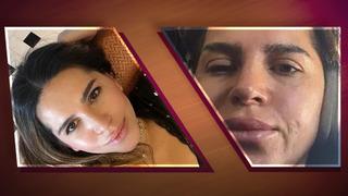 Estetikte büyük tehlike! Gençlik aşısı oldu, yüz felci geçirdi: Yüzüm beton gibi oldu Uzmanlar uyardı: Yaptırmadan önce 2 kere düşünün