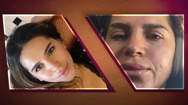 Estetikte büyük tehlike! Gençlik aşısı oldu, yüz felci geçirdi: Yüzüm beton gibi oldu Uzmanlar uyardı: Yaptırmadan önce 2 kere düşünün