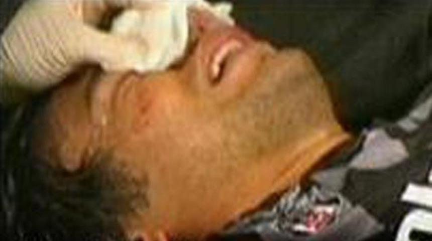 Toraman'ın burnu kırıldı