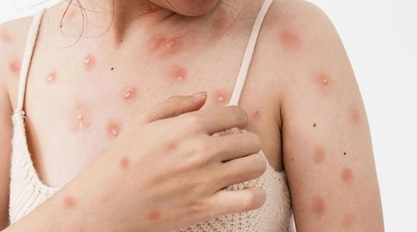 Salgın hastalık alarmı! Ülkenin 10 şehrinde tespit edildi! Vakalar artıyor, herkes tedirgin...