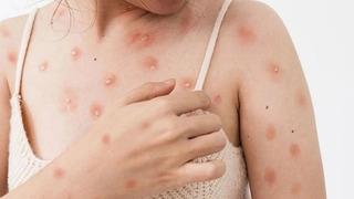 Salgın hastalık alarmı! Ülkenin 10 şehrinde tespit edildi! Vakalar artıyor, herkes tedirgin...