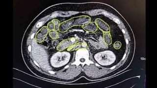 3 şüphelinin mide ve bağırsaklarından uyuşturucu çıktı