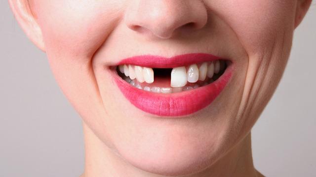 Ağız sağlığına dikkat! IBS’nin gizli nedeni dişleriniz olabilir: Riski yüzde 103 oranında artırıyor! Diş eksikliği bağırsağı bozar mı? Diş eksikliği belirtileri nelerdir?