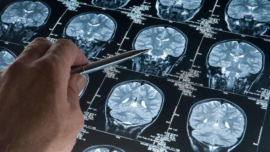 Alzheimer araştırmalarında riski artıran genetik varyant bulundu 1