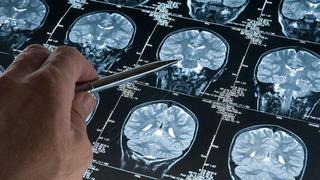 Erkeklerde gizli tehlike! Alzheimer araştırmalarında, demans riskini artıran genetik varyant bulundu: Bu varyanta sahip erkeklerde gelişme riski 2,39