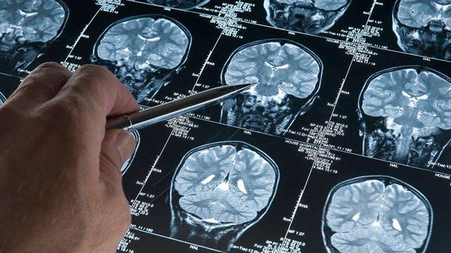 Erkeklerde gizli tehlike! Alzheimer araştırmalarında, demans riskini artıran genetik varyant bulundu: Bu varyanta sahip erkeklerde gelişme riski 2,39