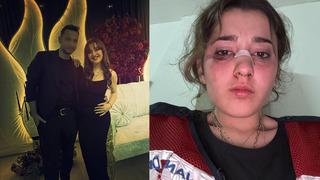 Nişanlı çiftin tatili kabusa döndü! Plajda kafa atıp, motosiklet kaskıyla dövdü