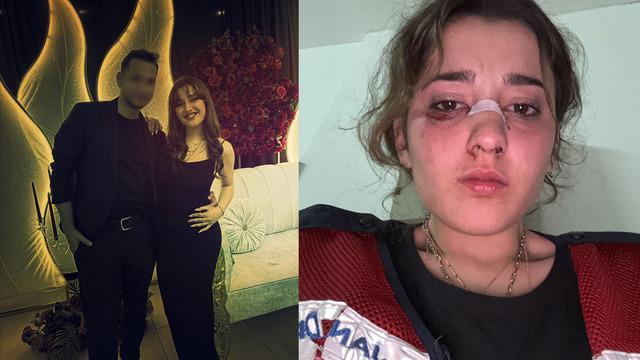 Nişanlı çiftin tatili kabusa döndü! Plajda kafa atıp, motosiklet kaskıyla dövdü