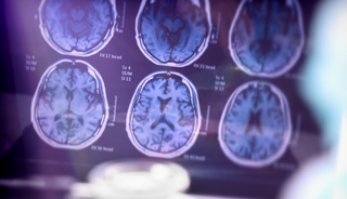 Alzheimer araştırmalarında riski artıran genetik varyant bulundu