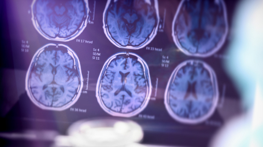 Alzheimer araştırmalarında riski artıran genetik varyant bulundu