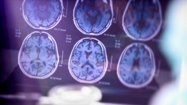 Alzheimer araştırmalarında riski artıran genetik varyant bulundu