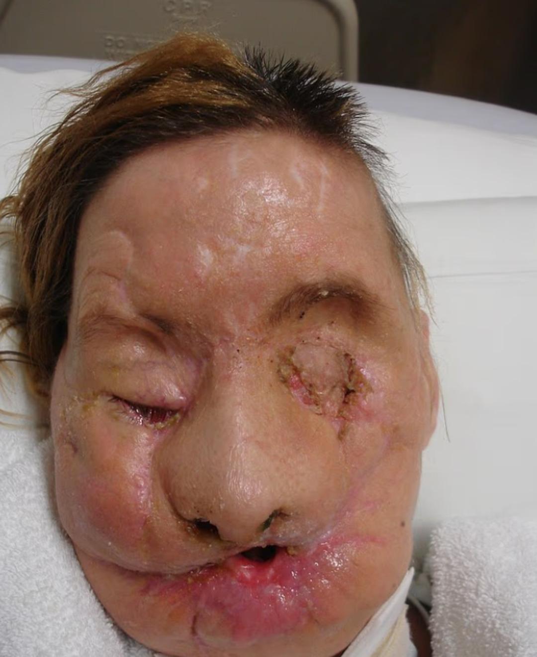 Şempanze yüzünü parçalamıştı! Yüz nakli olan kadın son halini yıllar sonra gösterdi 3