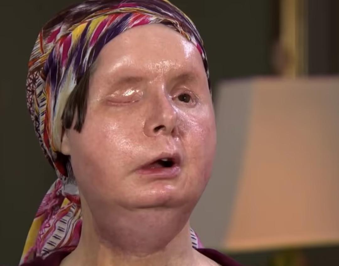 Şempanze yüzünü parçalamıştı! Yüz nakli olan kadın son halini yıllar sonra gösterdi 4