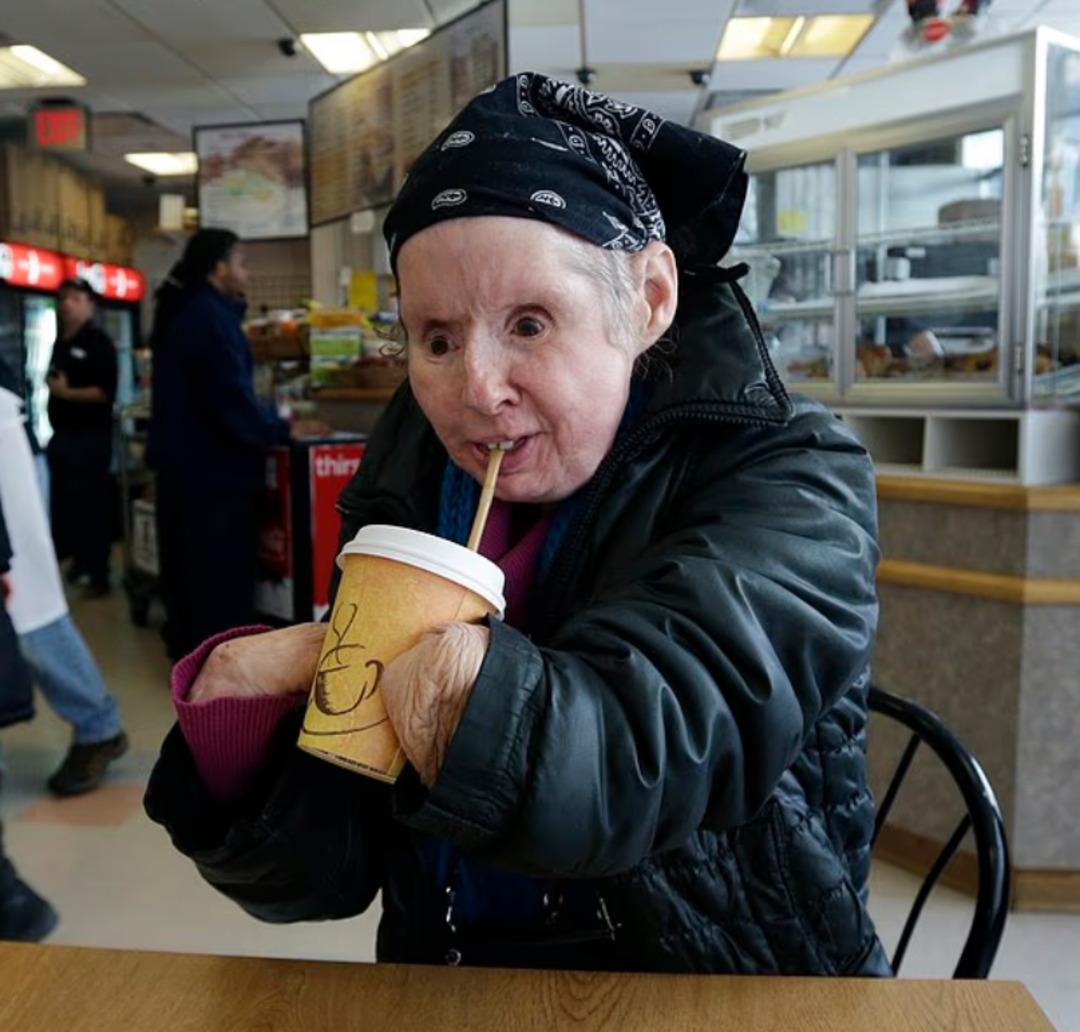 Şempanze yüzünü parçalamıştı! Yüz nakli olan kadın son halini yıllar sonra gösterdi 5