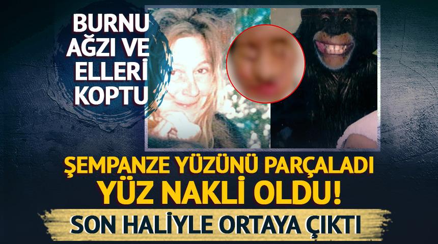 Şempanze yüzünü parçalamıştı! Yüz nakli oldu: İşte son hali