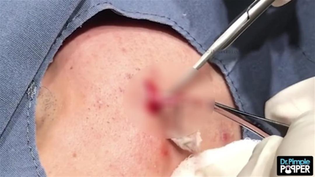 Y&uuml;z&uuml;nden &ouml;yle bir şey &ccedil;ıktı ki