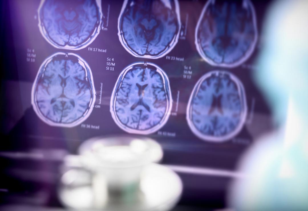 Tedavisi olmayan hastalıkta şaşırtan vaka! Daha 19 yaşında alzheimer tanısı konuldu... 1