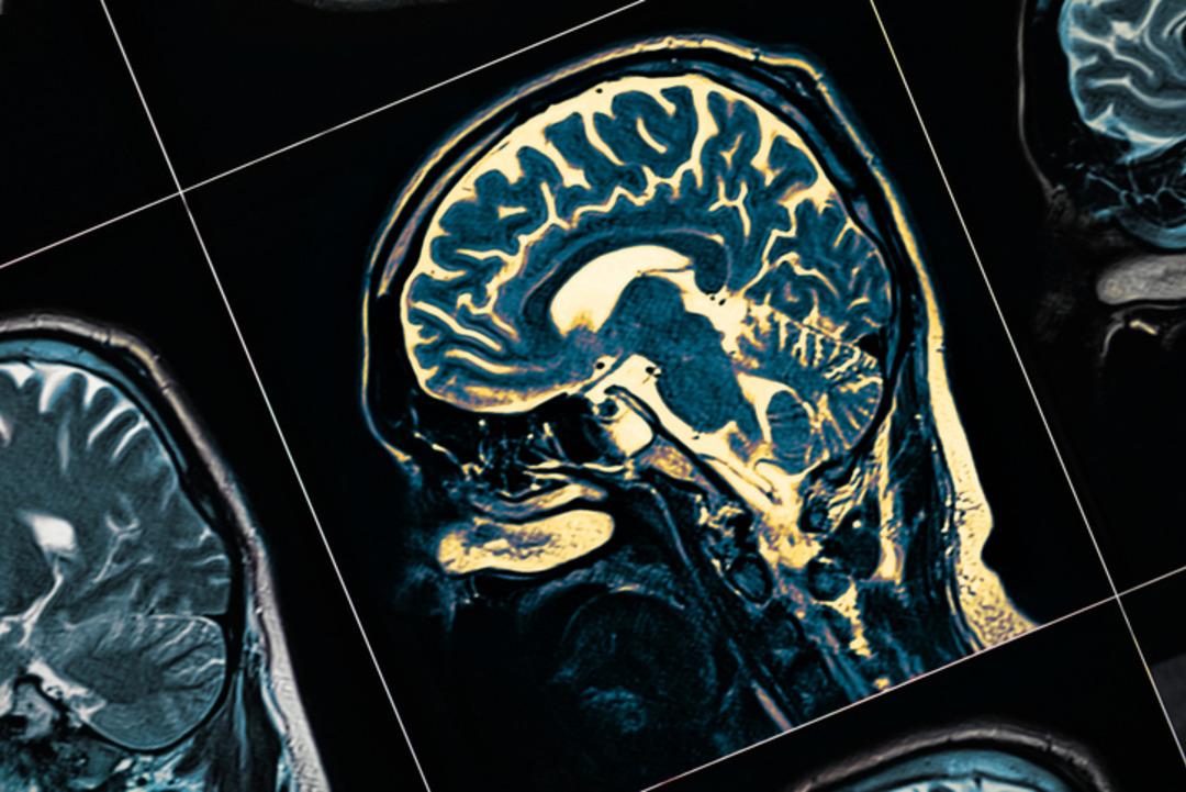 Tedavisi olmayan hastalıkta şaşırtan vaka! Daha 19 yaşında alzheimer tanısı konuldu... 2