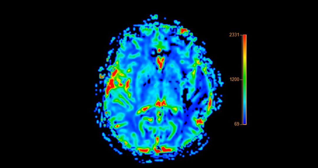 Tedavisi olmayan hastalıkta şaşırtan vaka! Daha 19 yaşında alzheimer tanısı konuldu... 3