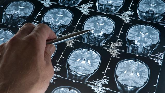 Tedavisi olmayan hastalıkta şaşırtan vaka! Daha 19 yaşında alzheimer tanısı konuldu...