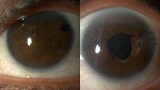 Doğuştan göz bebeği kaymış! Bir ameliyatla, 20 yıl sonra net görmeye başladı: “Dünyaları verseler almazdım; bana gözümü verdiler” 